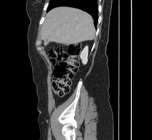 File:Ampullary tumor (Radiopaedia 60333-67998 C 8).jpg