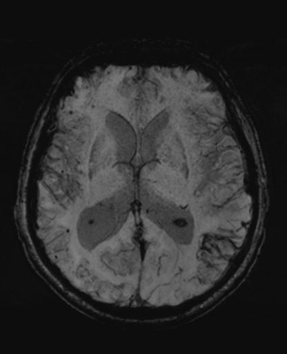 File:Amyloid angiopathy with inflammation (Radiopaedia 30360-31002 Axial SWI MIP 29).jpg
