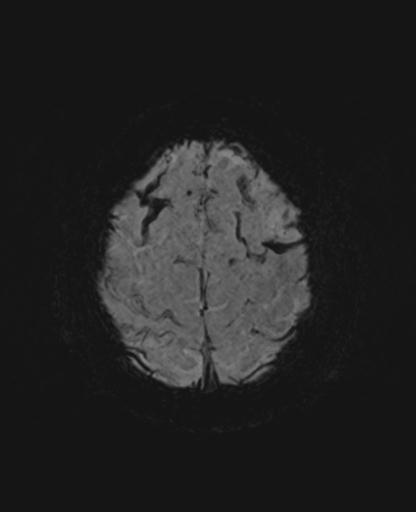 File:Amyloid angiopathy with inflammation (Radiopaedia 30360-31002 Axial SWI MIP 55).jpg