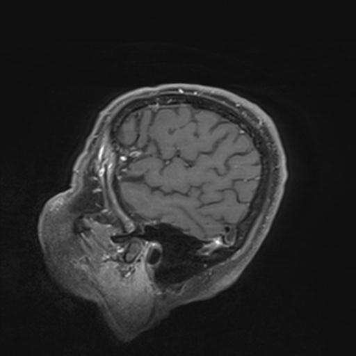 Amyloid angiopathy with inflammation (Radiopaedia 30360-31002 M 21).jpg