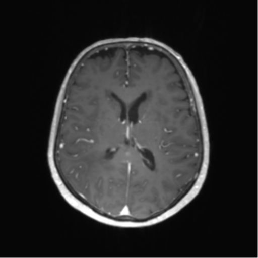File:Anaplastic astrocytoma (Radiopaedia 86943-103160 Axial T1 C+ 38).png