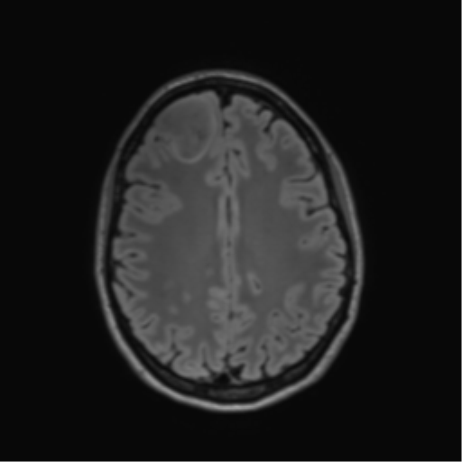 File:Anaplastic astrocytoma IDH mutant (Radiopaedia 50046-55341 Axial FLAIR 34).png