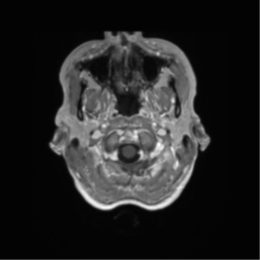 File:Anaplastic astrocytoma IDH mutant (Radiopaedia 50046-55341 Axial T1 C+ 4).png