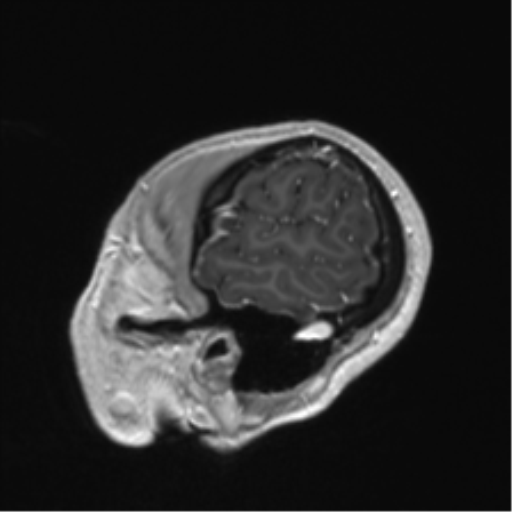 Anaplastic astrocytoma IDH mutant (Radiopaedia 50046-55341 Sagittal T1 C+ 13).png