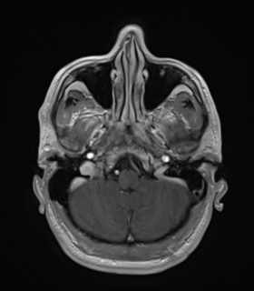 Anaplastic astrocytoma IDH wild-type (Radiopaedia 49984-55273 Axial T1 C+ 12).png