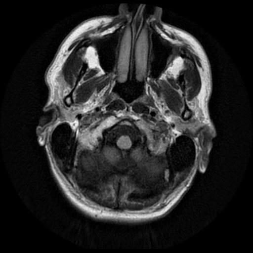 File:Anaplastic meningioma with recurrence (Radiopaedia 34452-35790 Axial T2 FLAIR 1).png