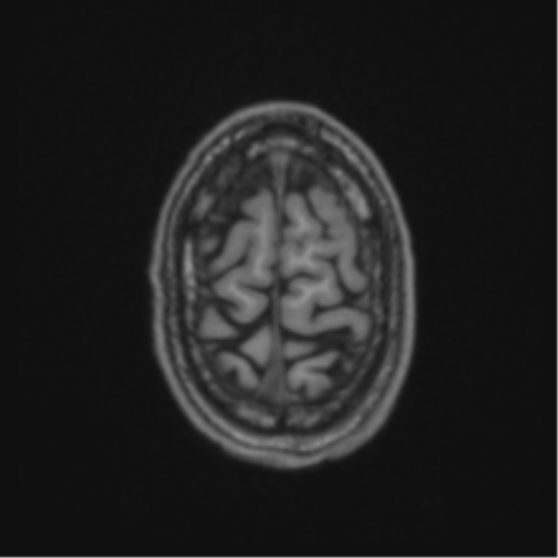 Anaplastic oligodendroglioma with skull fracture (Radiopaedia 74831-85845 Axial T1 60).png