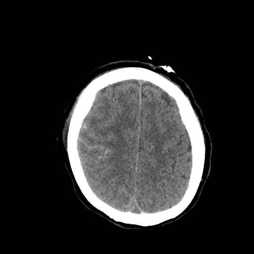 Aneursym related subarachnoid hemorrhage with hydrocephalus (Radiopaedia 45105-49085 Axial non-contrast 40).jpg