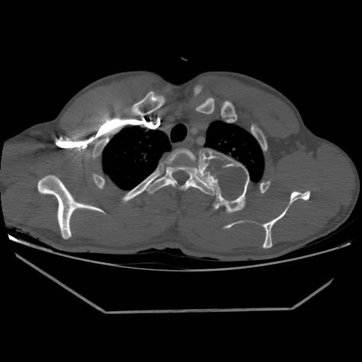 Aneurysmal bone cyst - rib (Radiopaedia 82167-96220 Axial bone window 65).jpg
