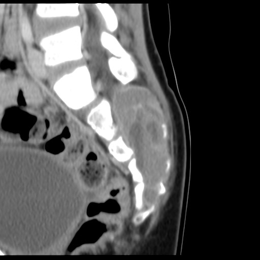 File:Aneurysmal bone cyst - sacrum (Radiopaedia 65190-74195 A 12).jpg