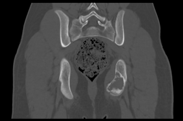 File:Aneurysmal bone cyst of ischium (Radiopaedia 25957-26094 Coronal bone window 31).png