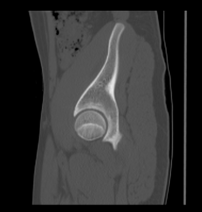 Aneurysmal bone cyst of ischium (Radiopaedia 25957-26094 Sagittal bone window 20).png
