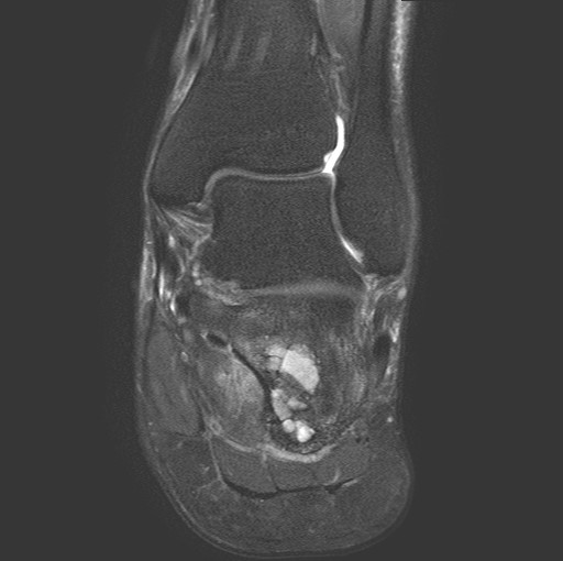 File:Aneurysmal bone cyst of the calcaneus (Radiopaedia 60669-68420 Coronal T2 fat sat 11).jpg