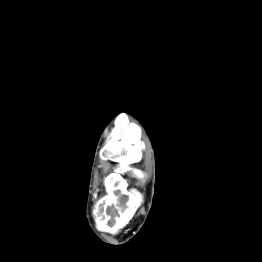 File:Aneurysmal bone cyst of the calcaneus (Radiopaedia 60669-68421 A 25).jpg