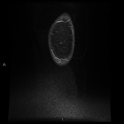 Angioleiomyoma (Radiopaedia 85442-101078 F 8).jpg