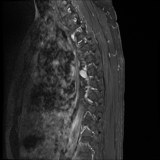 File:Angiolipoma - thoracic spine (Radiopaedia 28242-28479 E 3).jpg