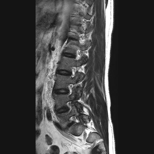 File:Ankylosing spondylitis with zygapophyseal arthritis (Radiopaedia 38433-40516 Sagittal T2 2).jpg