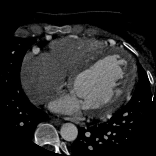 Anomalous left coronary artery from the pulmonary artery (ALCAPA) (Radiopaedia 40884-43586 A 52).jpg
