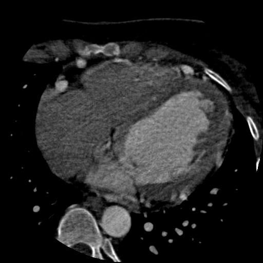 Anomalous left coronary artery from the pulmonary artery (ALCAPA) (Radiopaedia 40884-43586 A 53).jpg