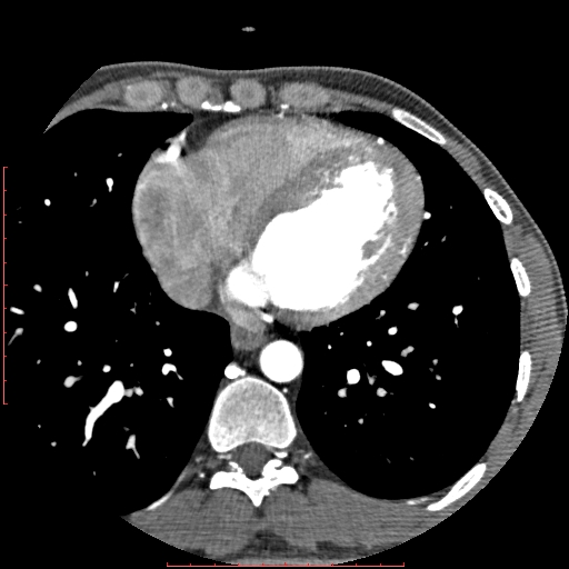 Anomalous left coronary artery from the pulmonary artery (ALCAPA) (Radiopaedia 70148-80181 A 241).jpg