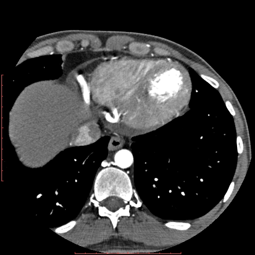 File:Anomalous left coronary artery from the pulmonary artery (ALCAPA) (Radiopaedia 70148-80181 A 328).jpg