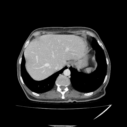 Anorectal carcinoma (Radiopaedia 44413-48064 A 8).jpg