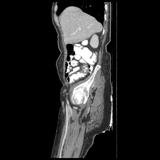 Anorectal carcinoma (Radiopaedia 44413-48064 C 17).jpg