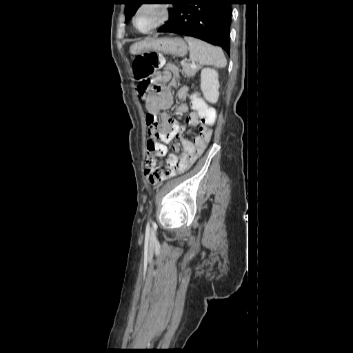 Anorectal carcinoma (Radiopaedia 44413-48064 C 87).jpg