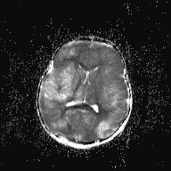 File:Anoxic brain injury (Radiopaedia 79165-92139 Axial ADC 16).jpg
