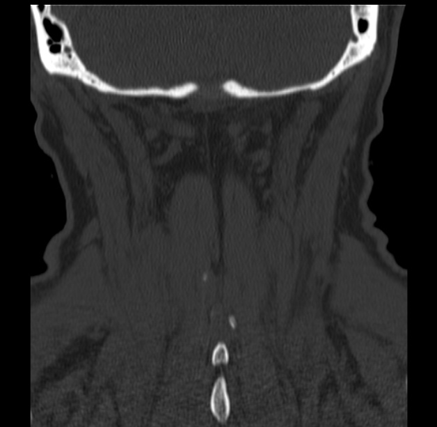 Anterior cervical postdiscectomy arthrodesis (Radiopaedia 32678-33646 Coronal bone window 61).jpg
