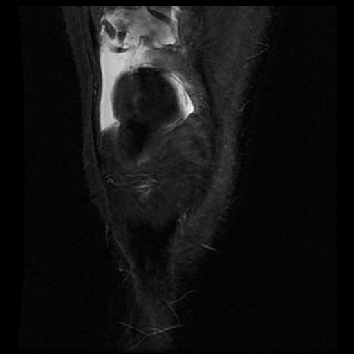 File:Anterior cruciate ligament avulsion fracture (Radiopaedia 58939-66193 Coronal STIR 4).jpg