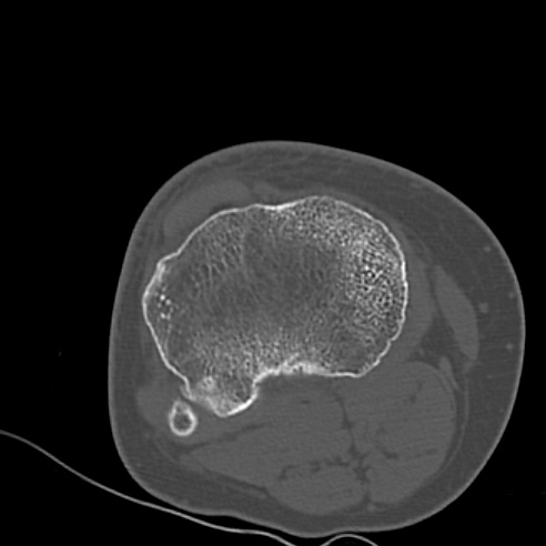 File:Anterior cruciate ligament avulsion fracture (Radiopaedia 58939-66194 Axial bone window 24).jpg
