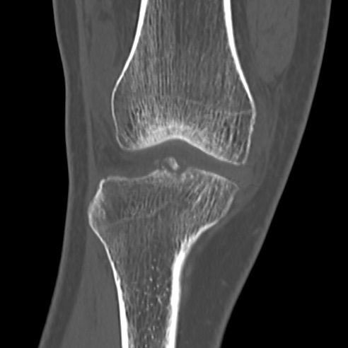File:Anterior cruciate ligament avulsion fracture (Radiopaedia 58939-66194 Coronal bone window 7).jpg