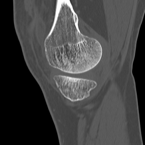 File:Anterior cruciate ligament avulsion fracture (Radiopaedia 58939-66194 Sagittal bone window 32).jpg