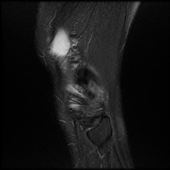 File:Anterior cruciate ligament graft tear and bucket-handle tear of medial meniscus (Radiopaedia 75867-87255 Sagittal PD fat sat 26).jpg