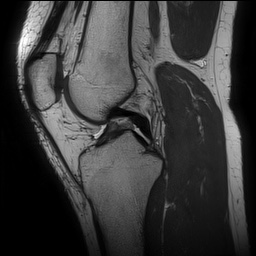 Anterior cruciate ligament rupture and posteromedial corner injury (Radiopaedia 67338-76723 Sagittal PD 80).jpg