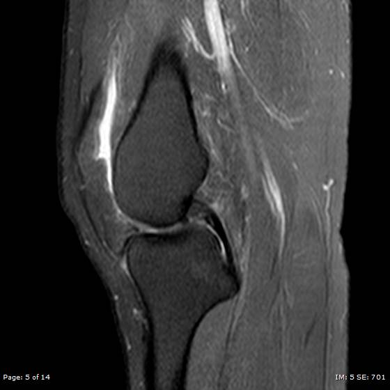 File:Anterior cruciate ligament tear (Radiopaedia 70783-80964 Sagittal PD fat sat 5).jpg