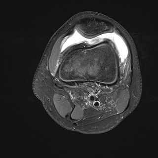 File:Anterior cruciate ligament tear - pediatric (Radiopaedia 62152-70260 Axial PD fat sat 8).jpg