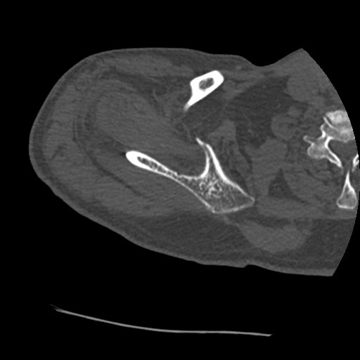 Anterior glenohumeral dislocation with Hill-Sachs lesion (Radiopaedia 62877-71249 Axial bone window 21).jpg