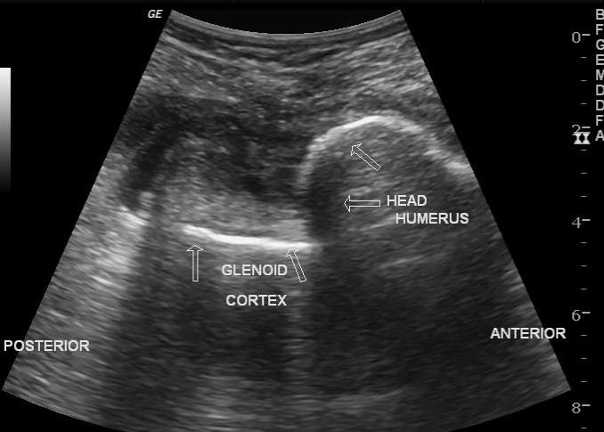 File:Anterior shoulder dislocation - ultrasound (Radiopaedia 23060-23090 Transverse 1).jpg