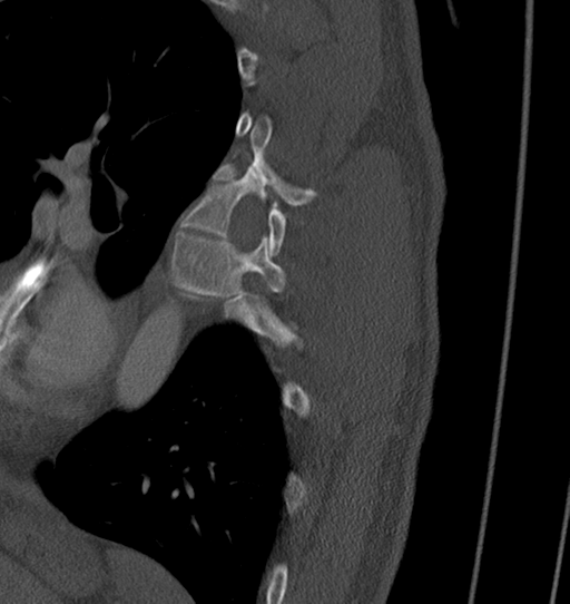 Anterior shoulder dislocation with Hill-Sachs and bony Bankart lesions (Radiopaedia 40424-42974 Sagittal bone window 78).png