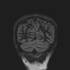 Anterior temporal encephalocele (Radiopaedia 82624-96808 Coronal FLAIR 44).jpg