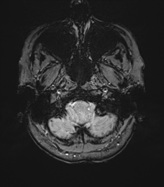 Anterior temporal lobe perivascular space (Radiopaedia 40946-43650 Axial SWI 8).png