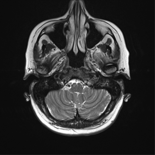 File:Anterior temporal lobe perivascular space (Radiopaedia 40946-43650 Axial T2 6).png