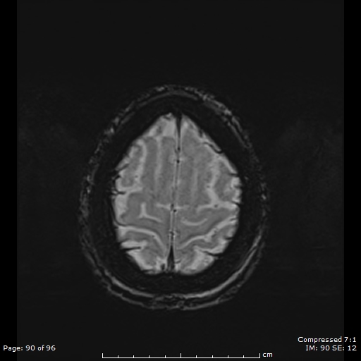 Anterior temporal lobe perivascular space (Radiopaedia 88283-104914 Axial SWI 59).jpg