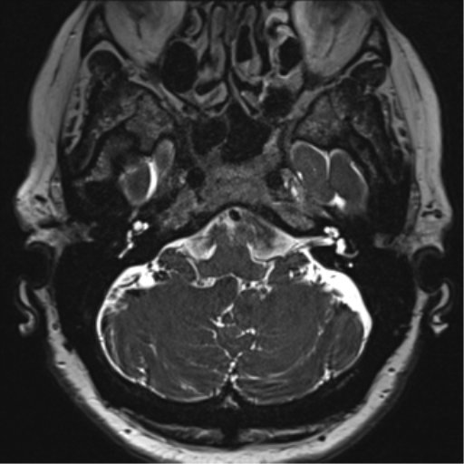 Anterior temporal pole cysts (Radiopaedia 46629-51102 Axial T2 26).png