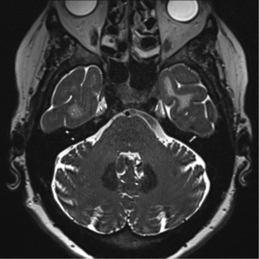 Anterior temporal pole cysts (Radiopaedia 46629-51102 Axial T2 40).png
