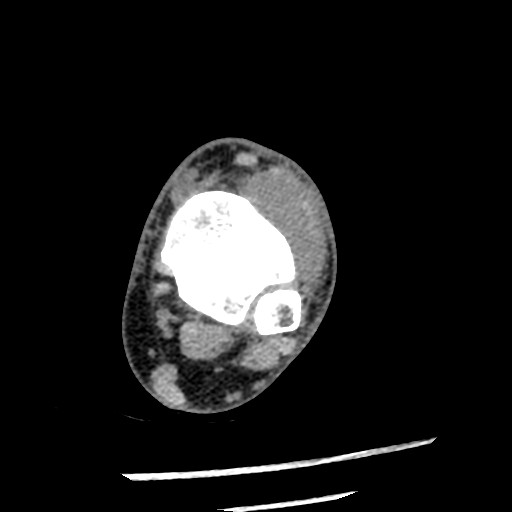 Anterior tibial artery false aneurysm (Radiopaedia 88984-105809 A 99).jpg