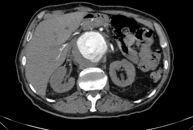 File:Anterior vertebral scalloping (abdominal aortic aneurysm) (Radiopaedia 66744-76067 F 18).jpg