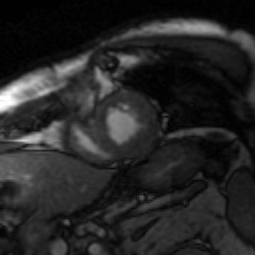 File:Anteroseptal hypokinesia after myocardial infarction (Radiopaedia 15978-15633 Short axis SSFE 8).jpg